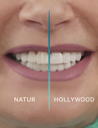 Veneera-Zahn-Veneers-Zahn-VeneerFarbvergleichClose-min